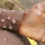 Russia’s 10-year monkeypox virus work outbreaks in 2022