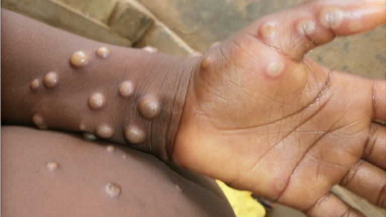 Russia’s 10-year monkeypox virus work outbreaks in 2022